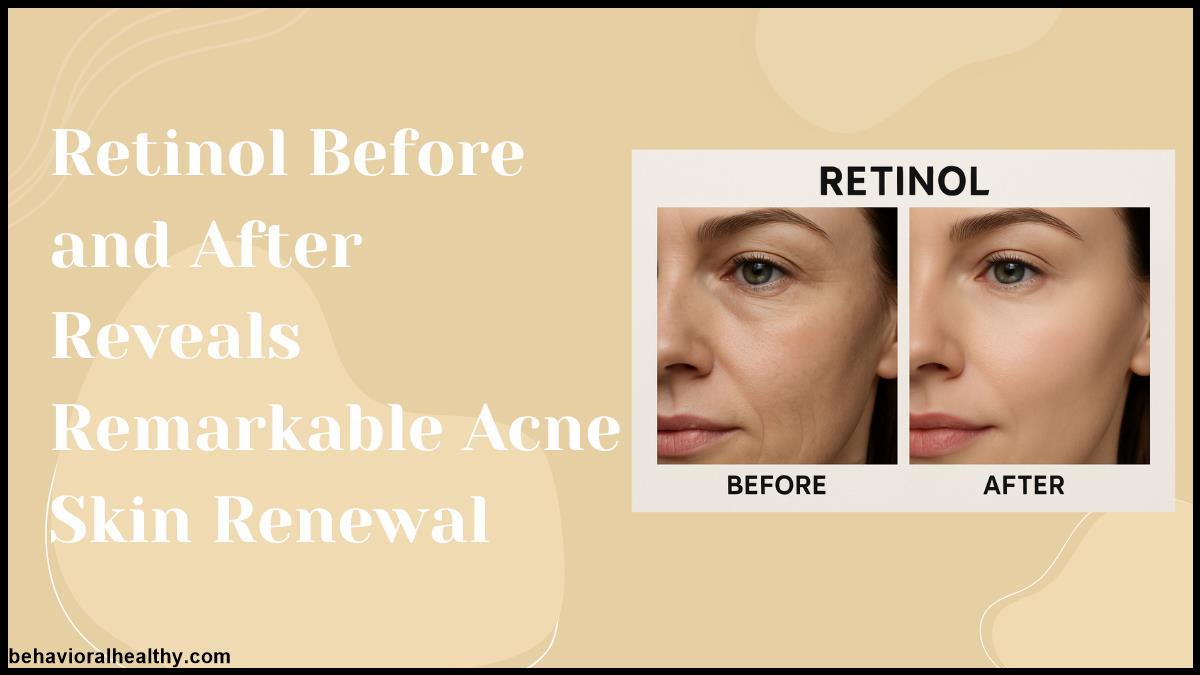 Retinol Before and After Reveals Remarkable Acne Skin Renewal.jpg